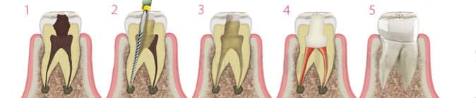 La endodoncia o tratamiento de conducto