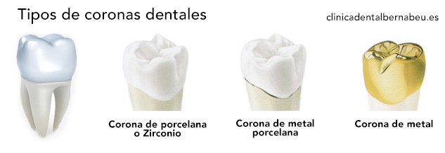Coronas o fundas dentales de circonio
