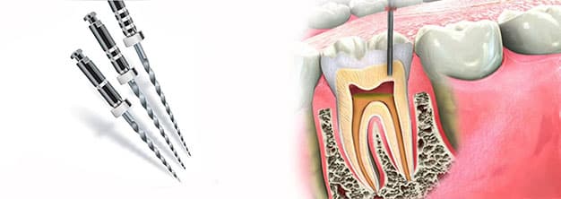 ¿Qué es la endodoncia multirradicular?