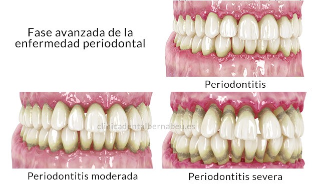 Periodontitis, diferencia con la gingivitis