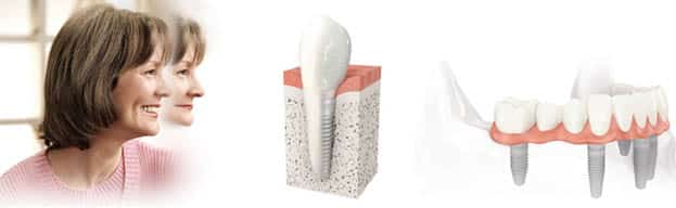 ¿Cuál es el precio del implante dental tratamiento de alta gama?