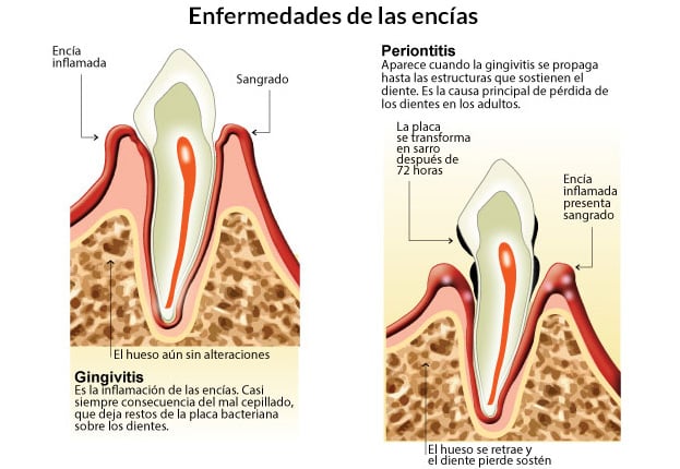 Desde la de gingivitis a la periodontitis