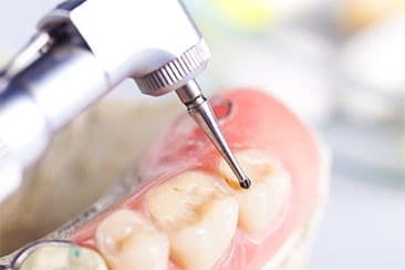 Síntomas ¿Cómo se diagnostica la necesidad de una endodoncia?