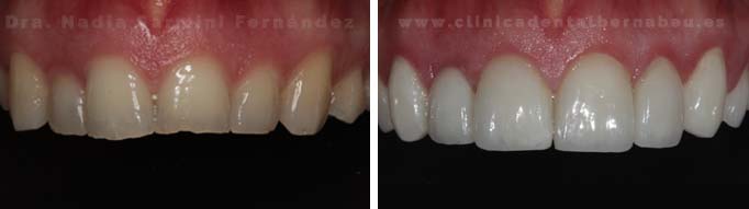 Cambio de forma y color de los dientes | Carillas cerámica e.max