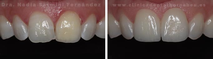 Carillas Antes y después | Restauración de incisivos centrales. 2 carillas cerámicas.