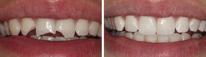 Antes / después | Fractura dental, restauración con composite.