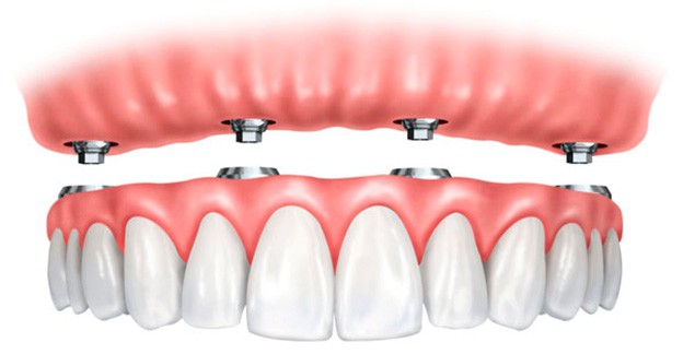Limpieza y mantenimiento de la dentadura híbrida