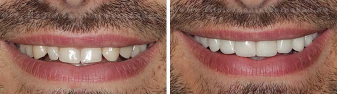 Antes y después | Carillas sin tallado dental