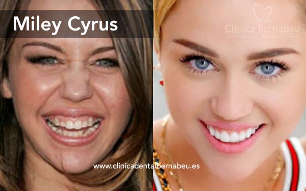 Estrellas como Miley Cyrus, Demi Moore o Zac Efron han realizado este tipo de tratamiento consiguiendo una verdadera sonrisa de Hollywood.