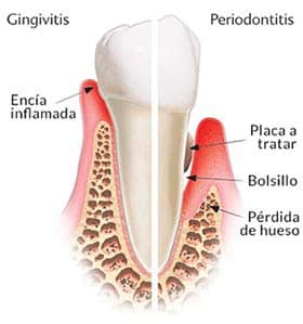 gingivitis-sintomas