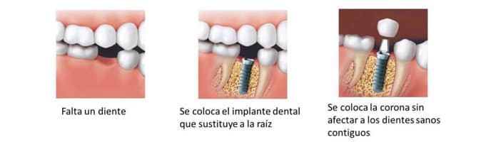 Factores que afectan a el precio del los implantes dentales