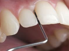 periodontitis-piorrea