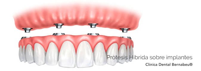 Prótesis dental Híbrida ( Sobre 4 o 6 implantes)