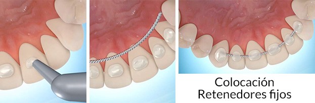 Retenedor de ortodoncia removibles o férulas