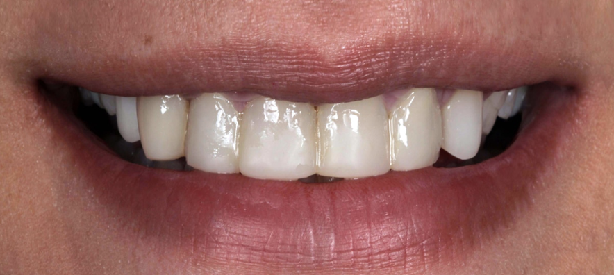 Boca antes de tratamiento de carillas dentales de porcelana o composite