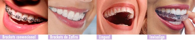 Dentro de la especialidad de la Ortodoncia podemos diferenciar distintos tipos2