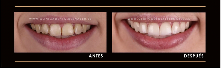 Ejemplo de antes y después de tratamiento de carillas de composite en Madrid