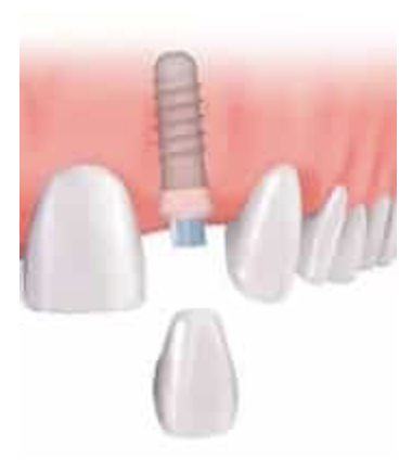 Ejemplo de tratamiento de coronas y fundas dentales