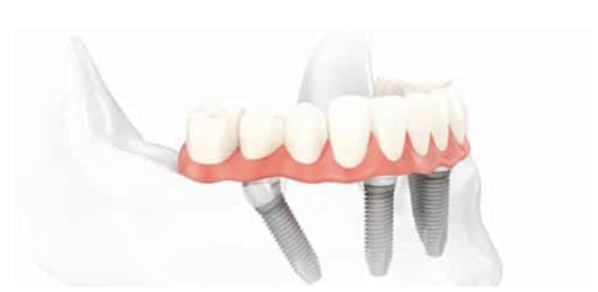 Proceso del tratamiento de implantología dental de carga inmediata