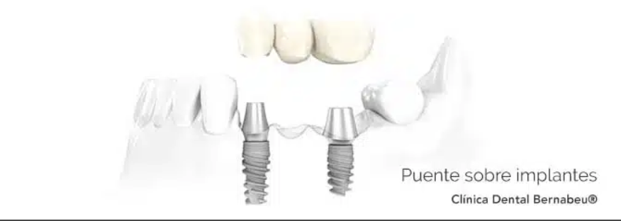 Puente sobre implantes en el tratamiento de prótesis dental en Madrid