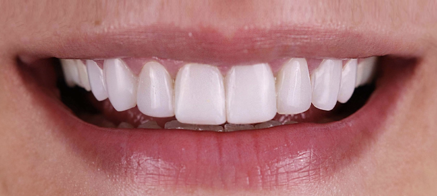 Resultado de tratamiento de carillas dentales de porcelana o composite