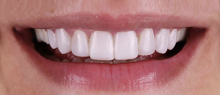 Resultado de una dentadura después del tratamiento de carillas de composite en Madrid