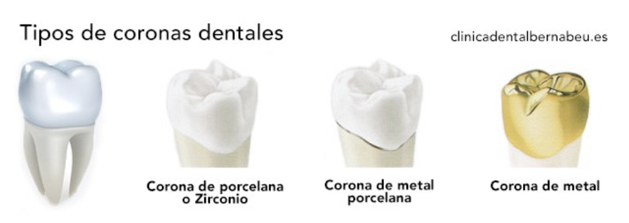 Tipos de coronas o funda dentales